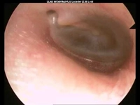 Kulakta Sıvı Toplanması Nedir? Kulakta Sıvı Toplanması Nedir?