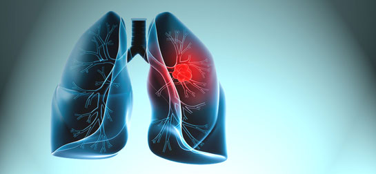 Akciğer Sıvı Toplaması Tedavisi
